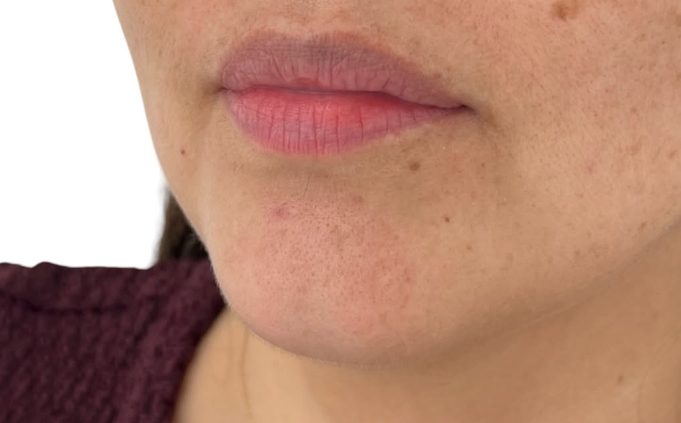 Antes — ácido hialurónico en labios