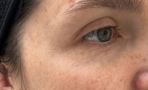 Antes — mesoterapia de vitaminas