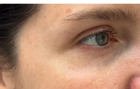 Después — mesoterapia de vitaminas