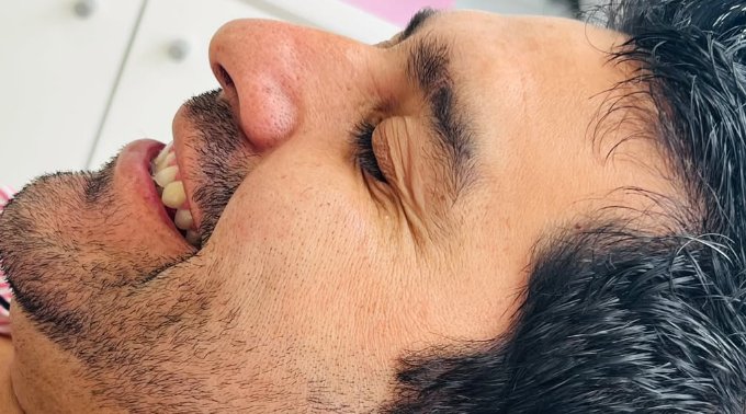 Tratamiento de toxina botulínica